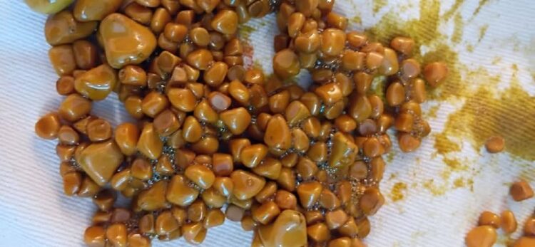 በወልዲያ ሆስፒታል ለአንዲት ወጣት በተደረገ ቀዶ ህክምና 534 የሀሞት ጠጠር ተወገደለዘጠኝ ዓመታት በህመም ስትሰቃይ የኖረችዉ …